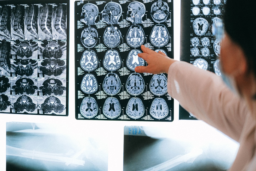 Radiopharm Schedules FDA Meeting on RAD101 Phase 3 Trial Design