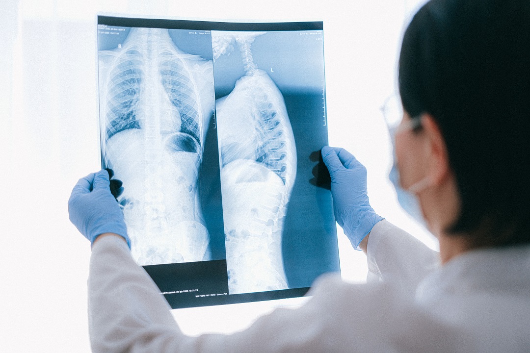 Rein Therapeutics Receives FDA Fast Track Status for LTI-03 in IPF