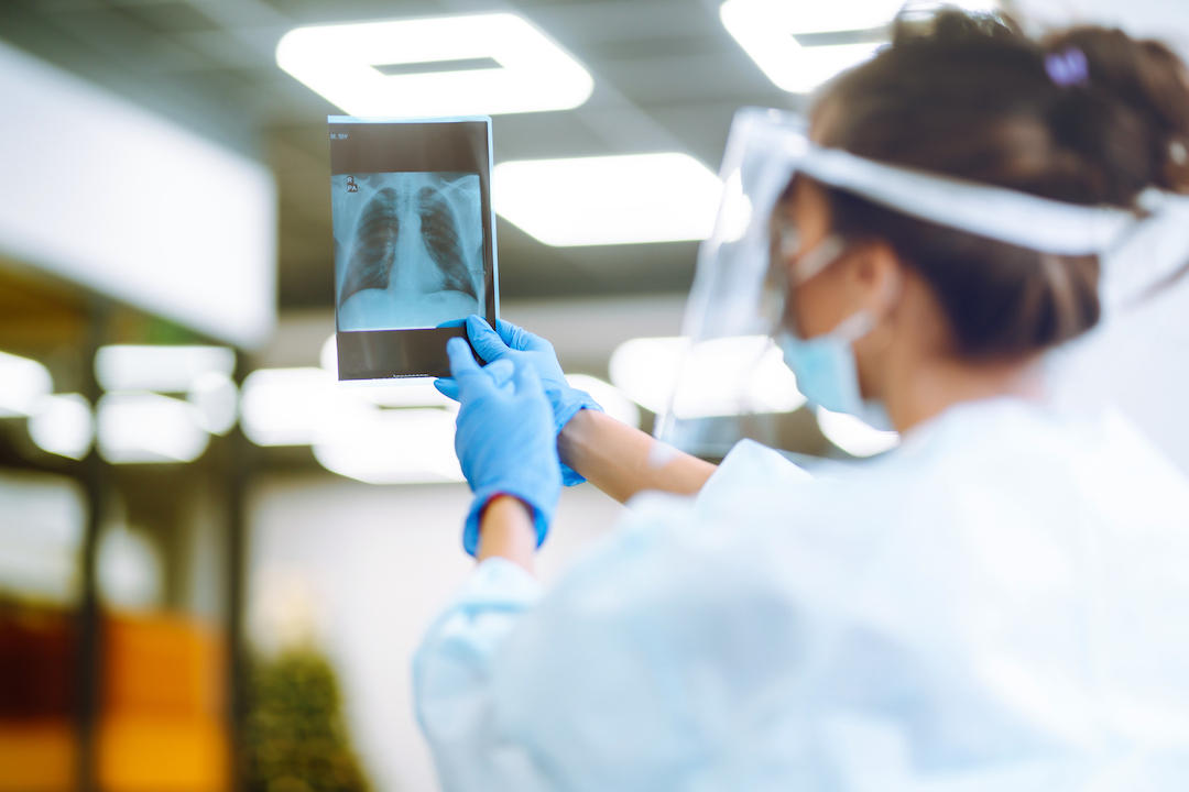 Zipalertinib Combo Halves Lung Cancer Progression Risk